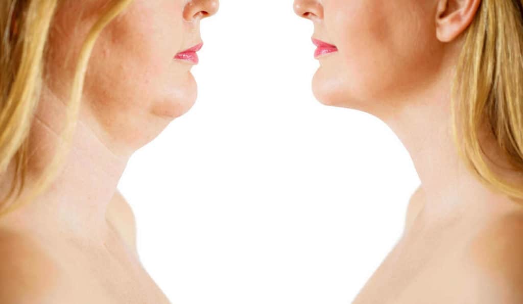 Double Chin treatment Stratford before and after results