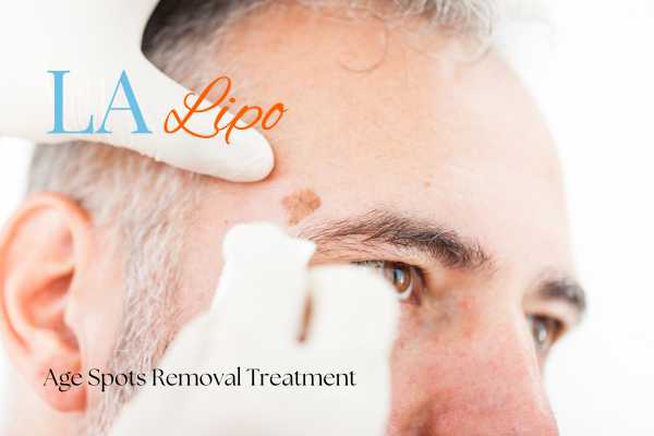 What Are the Most Effective Treatments for Age Spots Stratford?