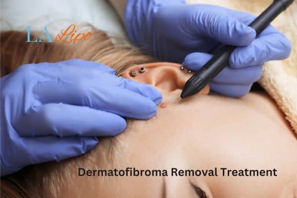 Dermatofibroma Removal Treatment Stratford