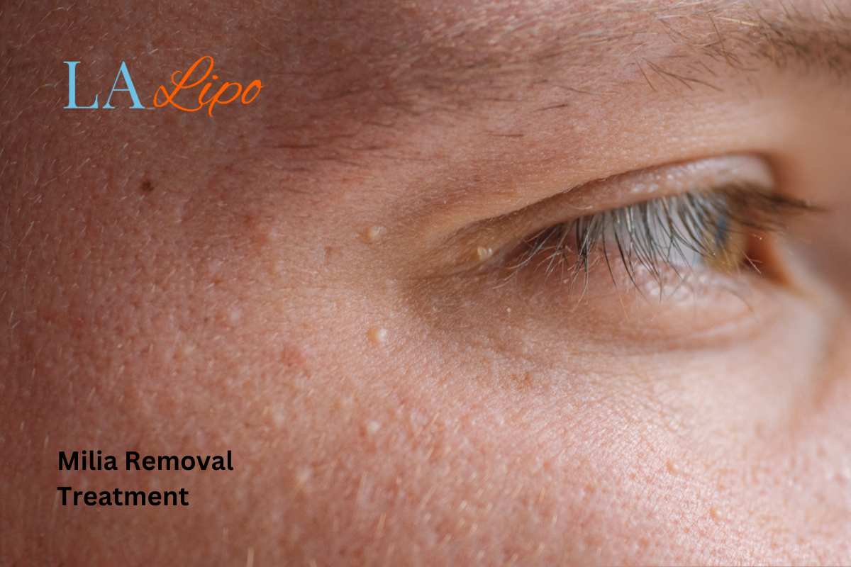 Cryopen Milia Removal: Is It the Easiest and Safest Option Stratford?