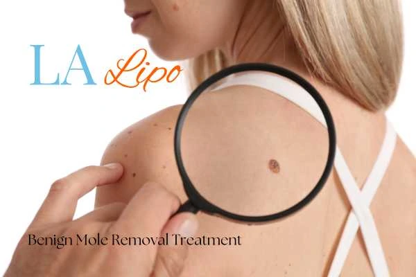 Woman having her inspection of blemish before mole removal Stratford