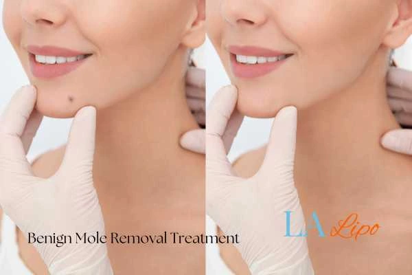 woman's before and after mole removal Stratford results