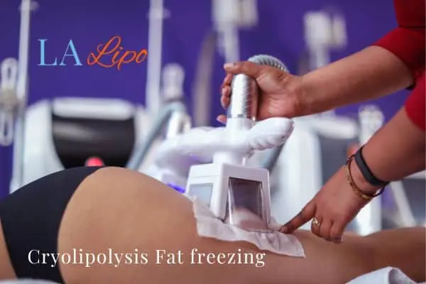 women getting fat freezing Stratford
