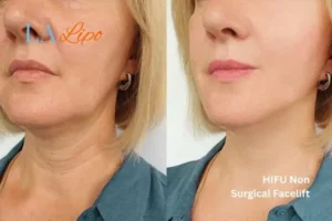 hi-fu for wrinkles Stratford before and after results