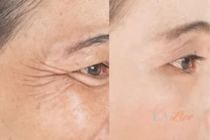 Before and after results of woman - HI-fu wrinkles reduction treatment Stratford