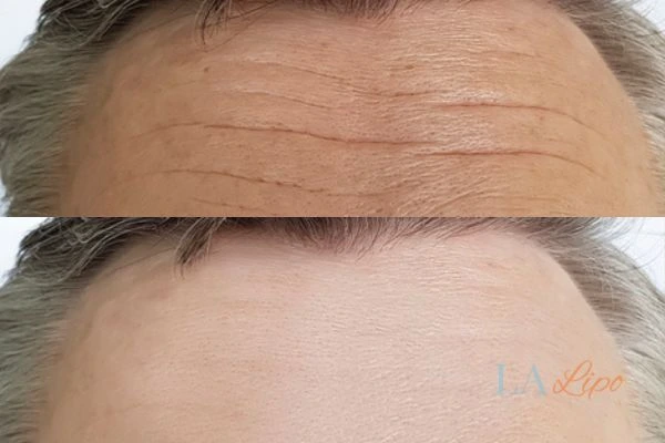 results of HIFU Stratford on mans forehead to help reduce lines and wrinkles