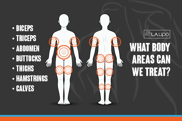 Graphic to show areas you can have LA-EMS Body Sculpting Stratford treatment.