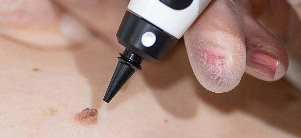 skin tag removal using cryopen Stratford
