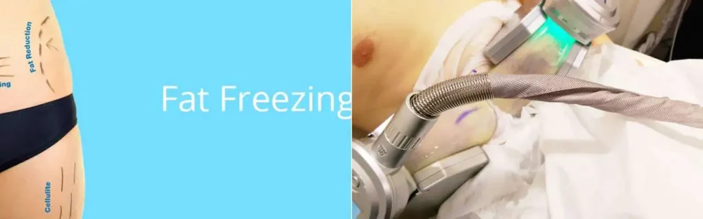 Fat freezing Stratford on multiple areas of the body