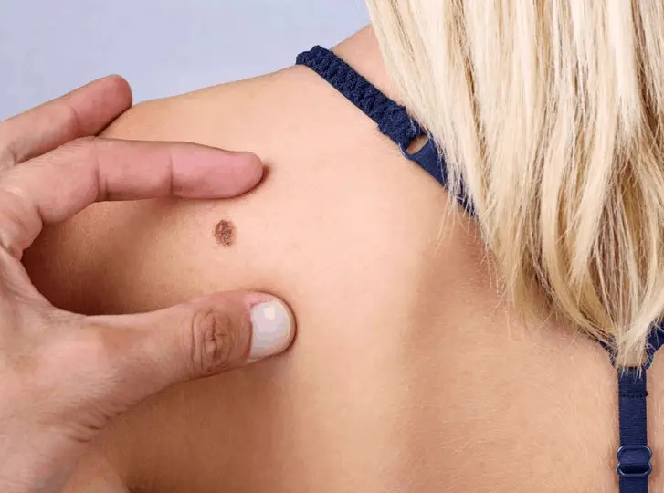 woman having mole removal Stratford consultation before treatment.