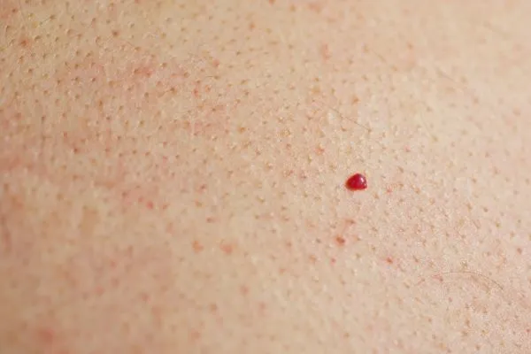 close up of a cherry angioma Stratford