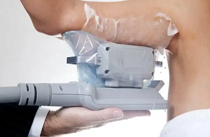 Picture of fat freezing Stratford on the upper arms.
