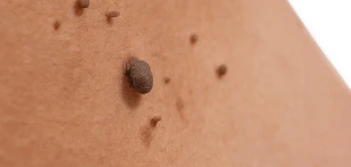 image of a skin tag Stratford