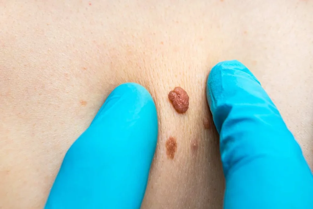 Consultant examining a skin tag Stratford