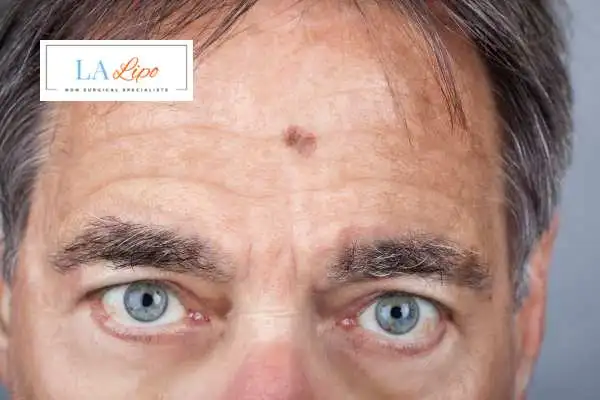 Solar Lentigo Removal Stratford image of man with mark on his forehead