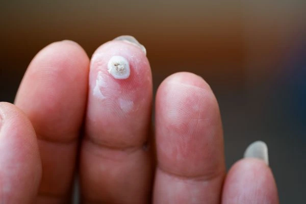wart on person finger - cryotherapy to treat from LA LIPO Stratford