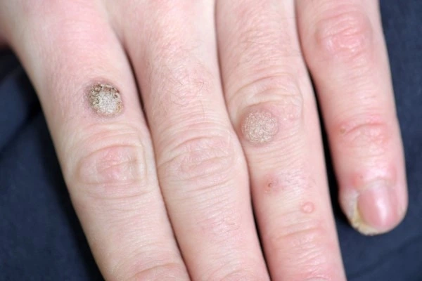 photo of warts on person hand - see wart removal Stratford from LA LIPO
