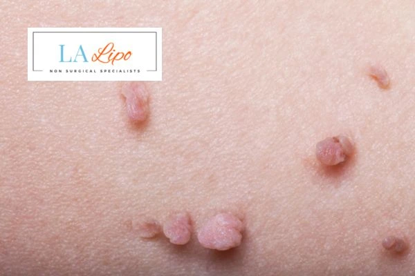 Does cryopen skin tag removal Stratford hurt? Find out now call our team today!
