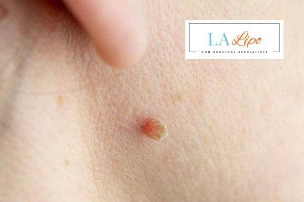 Book skin tag removal Stratford today speak to our team now!