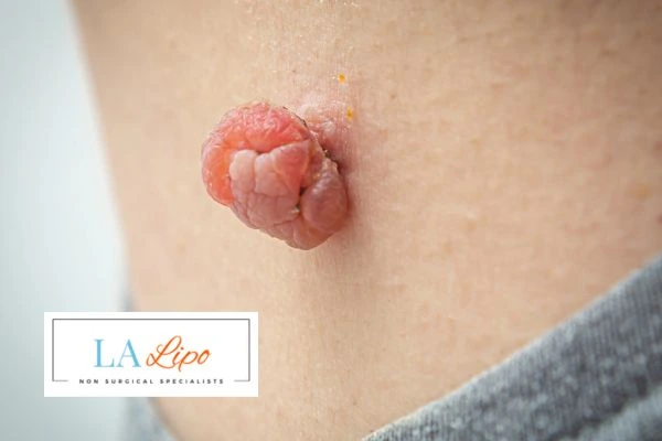 Interested in skin tag removal Stratford? Concerned about the pain? Find out more today!