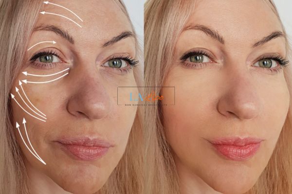 Morpheus 8 results Stratford face lift.