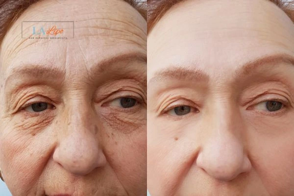 The powerful benefits of Morpheus8 Treatment Stratford - Call Our team today!
