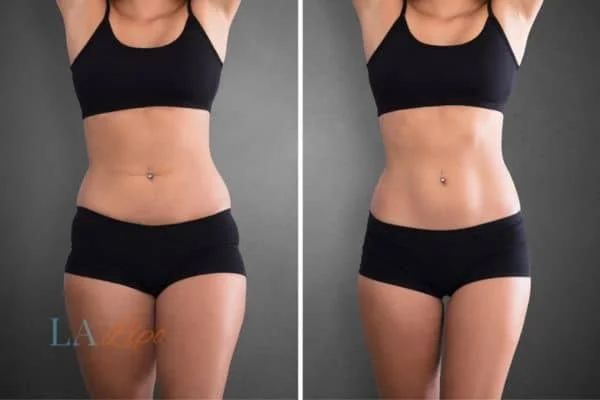 before and after results of non-surgical treatment to help a woman's body image and mental health Stratford