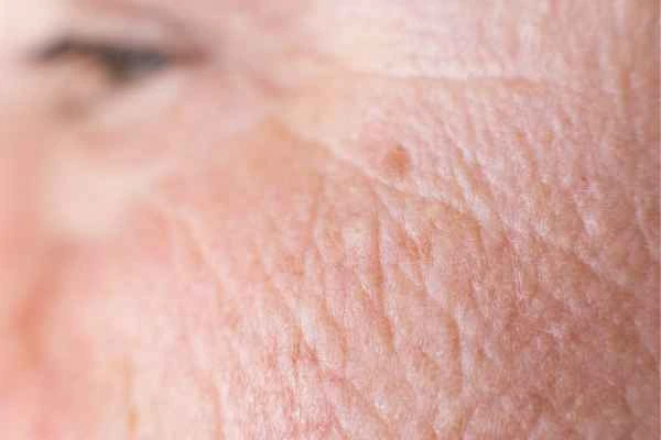 close up picture of a woman's face showing an age spot Stratford