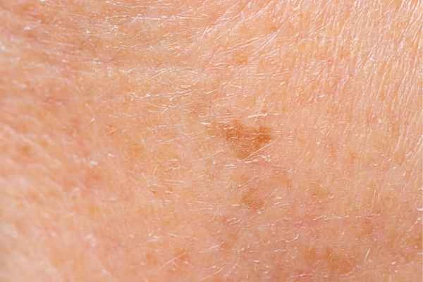 close up picture of age spots Stratford