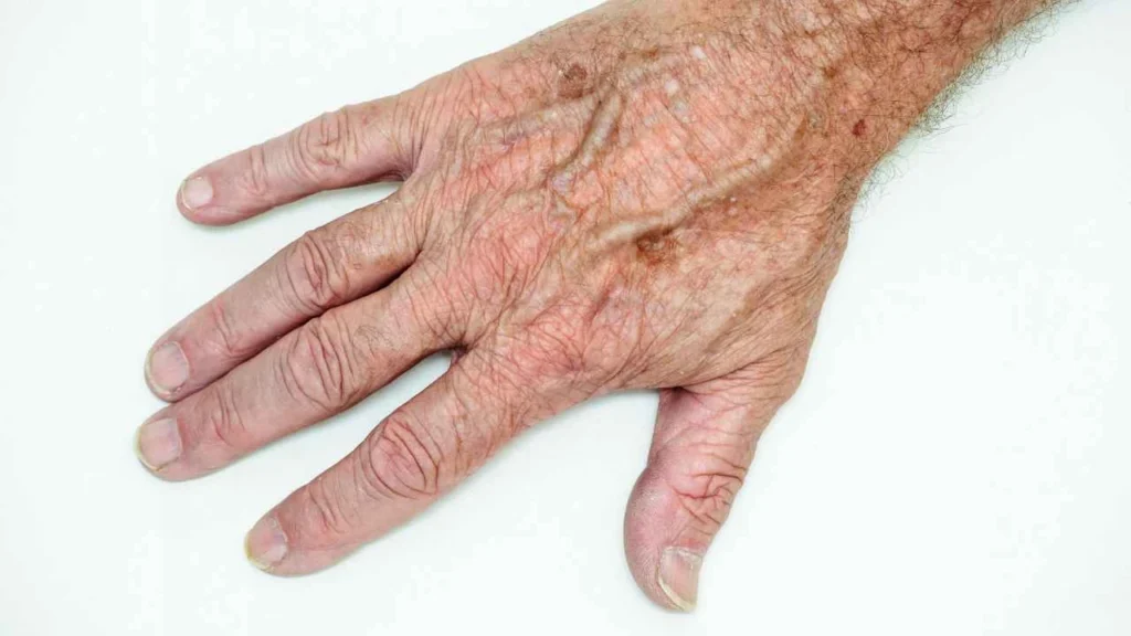 Male hand showing age spot Stratford