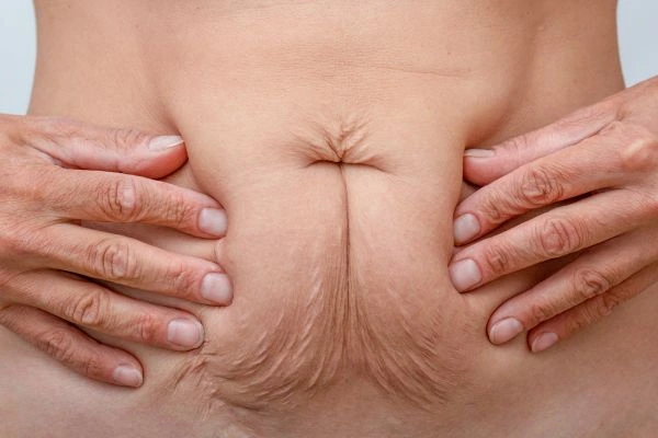 Image of a woman's stomach with loose skin - example of skin tightening Stratford options