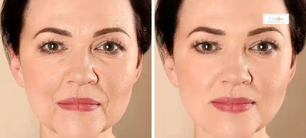How Long Does It Take to See Results and How Long Do They Last Stratford?