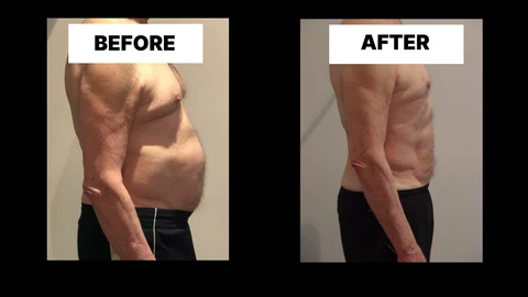 What Symptoms Can Diastasis Recti Cause in Men? Weak Core, Back Pain and Poor Posture Stratford